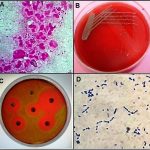 A-Gram-stain-of-pus-sample-oil-immersion-1000T-showing-numerous-PMN-cells-One-PMN