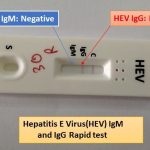 Hepatitis-E-VirusHEV-rapid-test