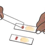 Thick-and-thin-blood-smear
