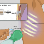 pleural-fluid-analysis-test
