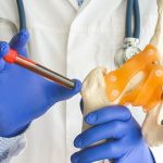 rheumatoid-factor